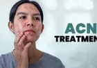 Acne Treatment At Home: एक्ने, पिंपल, ब्लैकहेड और दाग हटाने की पूरी गाइड