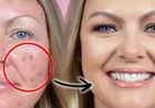 How to remove pimples permanently: साफ और चमकदार त्वचा के आसान तरीके